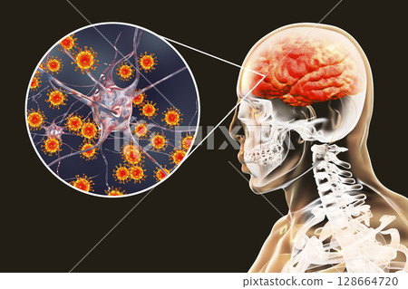 Viral meningitis and encephalitis, medical concept 128664720