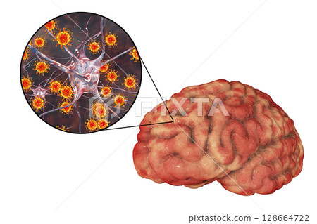 Viral meningitis and encephalitis, medical concept 128664722