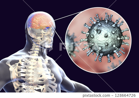 Varicella zoster virus encephalitis 128664726