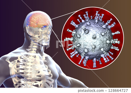 Varicella zoster virus encephalitis Varicella zoster virus encephalitis 128664727