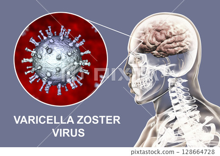 Varicella zoster virus encephalitis 128664728