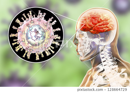 Varicella zoster virus encephalitis Varicella zoster virus encephalitis 128664729