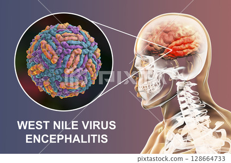 West Nile virus encephalitis 128664733