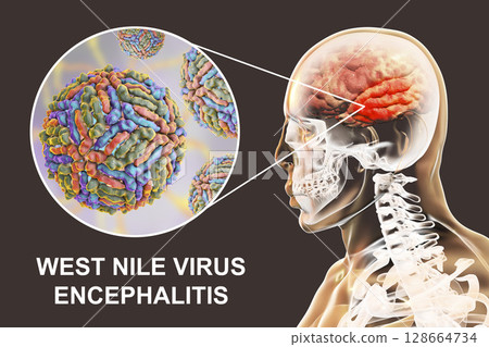 West Nile virus encephalitis West Nile virus encephalitis 128664734