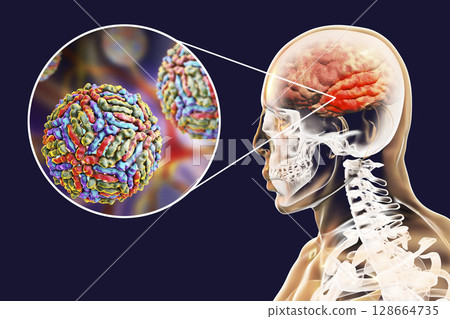 West Nile virus encephalitis 128664735