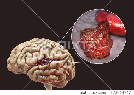 Hemorrhagic stroke, illustration Hemorrhagic stroke, illustration 128664747