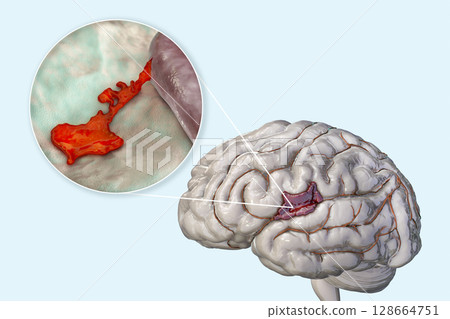 Hemorrhagic stroke, illustration Hemorrhagic stroke, illustration 128664751