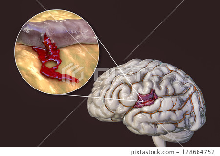 Hemorrhagic stroke, illustration Hemorrhagic stroke, illustration 128664752