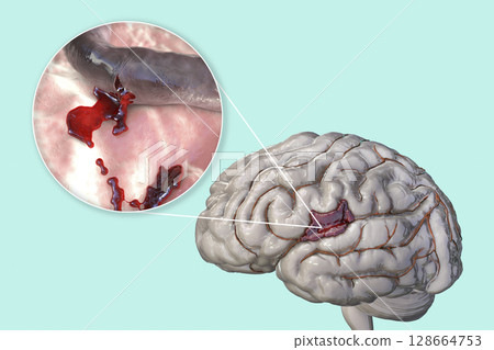 Hemorrhagic stroke, illustration 128664753