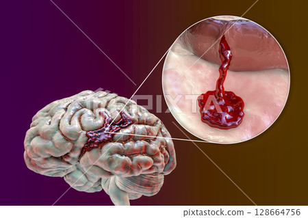Hemorrhagic stroke, illustration Hemorrhagic stroke, illustration 128664756