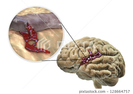 Hemorrhagic stroke, illustration Hemorrhagic stroke, illustration 128664757