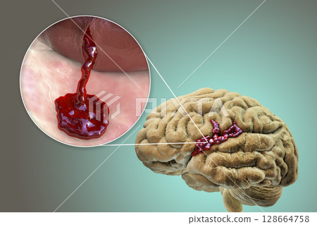 Hemorrhagic stroke, illustration Hemorrhagic stroke, illustration 128664758