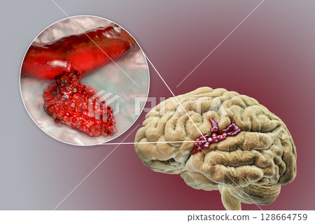Hemorrhagic stroke, illustration Hemorrhagic stroke, illustration 128664759