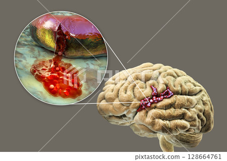 Hemorrhagic stroke, illustration Hemorrhagic stroke, illustration 128664761
