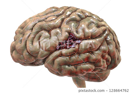 Hemorrhagic stroke, illustration Hemorrhagic stroke, illustration 128664762