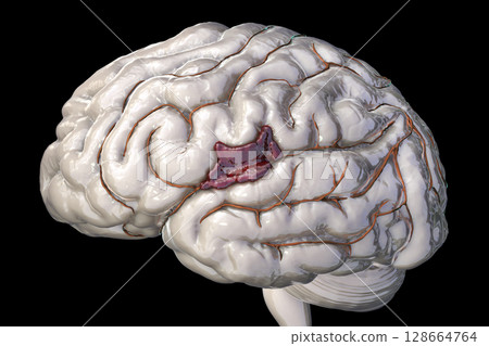 Hemorrhagic stroke, illustration 128664764