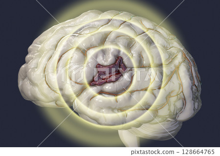 Hemorrhagic stroke, illustration Hemorrhagic stroke, illustration 128664765