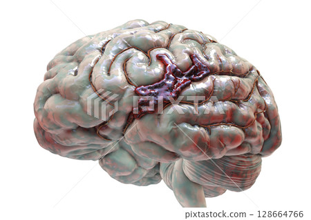 Hemorrhagic stroke, illustration 128664766
