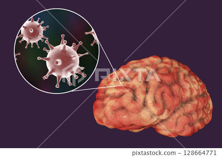 Herpes virus encephalitis, medical concept Herpes virus encephalitis, medical concept 128664771