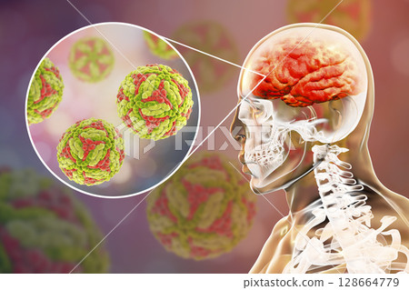 Japanese B encephalitis, medical concept Japanese B encephalitis, medical concept 128664779