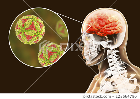 Japanese B encephalitis, medical concept Japanese B encephalitis, medical concept 128664780