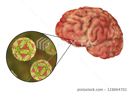 Japanese B encephalitis, medical concept Japanese B encephalitis, medical concept 128664781