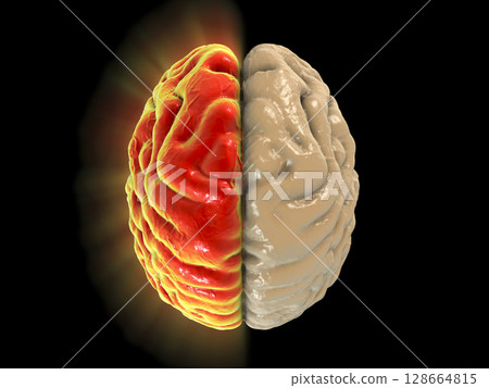 Migraine, hemicrania, medical concept 128664815