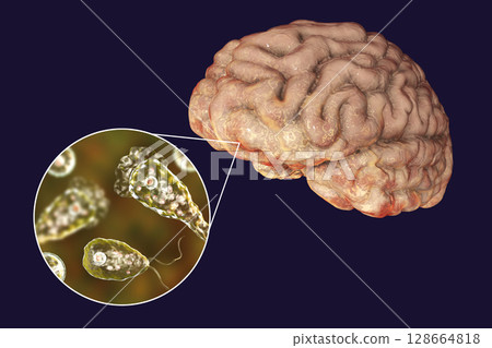 Brain-eating amoeba infection, naegleriasis Brain-eating amoeba infection, naegleriasis 128664818