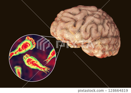Brain-eating amoeba infection, naegleriasis 128664819