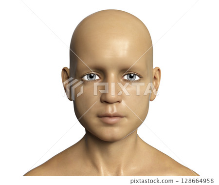 A child with alopecia 128664958