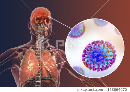 Influenza complications, encephalitis and pneumonia Influenza complications, encephalitis and pneumonia 128664970