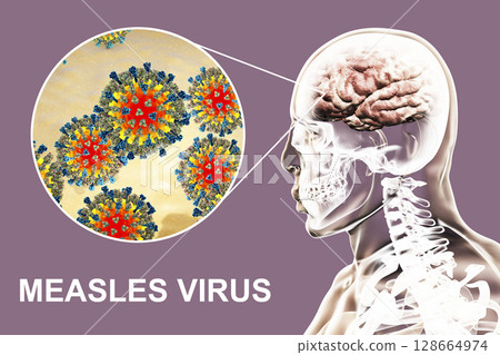 Measles induced encephalitis Measles induced encephalitis 128664974