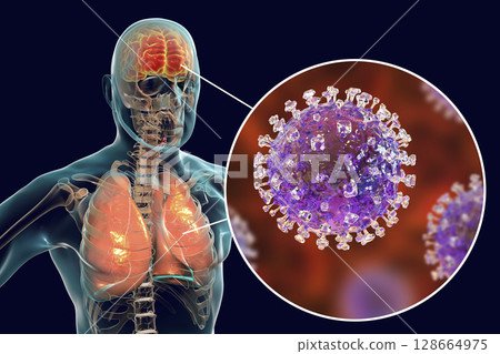 Nipah virus infection Nipah virus infection 128664975