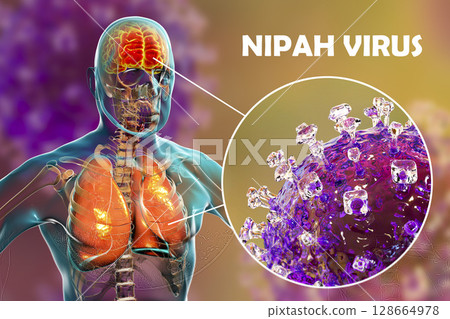 Nipah virus infection Nipah virus infection 128664978