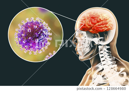Nipah virus infection 128664980