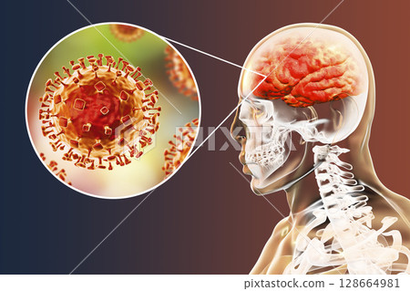 Nipah virus infection 128664981