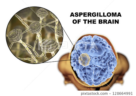 Aspergilloma of the brain and close-up view of fungi Aspergillus 128664991