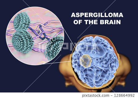 Aspergilloma of the brain and close-up view of fungi Aspergillus 128664992