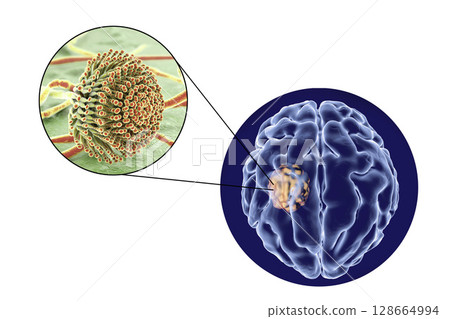 Aspergilloma of the brain and close-up view of fungi Aspergillus Aspergilloma of the brain and close-up view of fungi Aspergillus 128664994