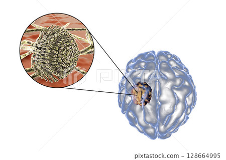 Aspergilloma of the brain and close-up view of fungi Aspergillus Aspergilloma of the brain and close-up view of fungi Aspergillus 128664995
