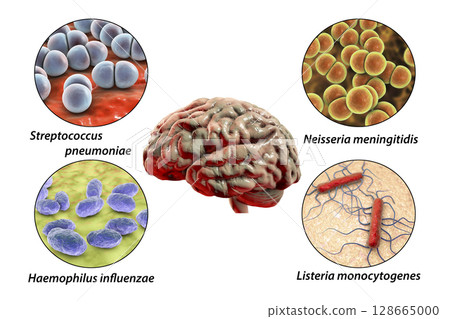 Etiology of bacterial meningitis Etiology of bacterial meningitis 128665000