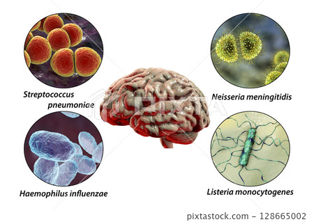 Etiology of bacterial meningitis Etiology of bacterial meningitis 128665002