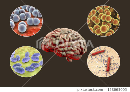 Etiology of bacterial meningitis Etiology of bacterial meningitis 128665003