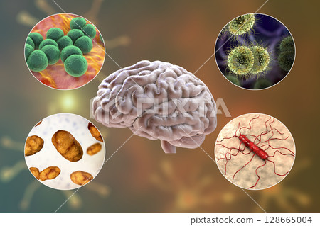 Etiology of bacterial meningitis Etiology of bacterial meningitis 128665004