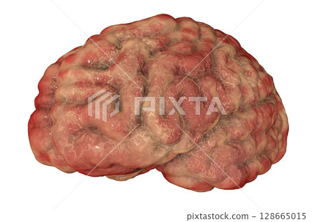 Encephalitis concept, illustration showing edema and hemorrhages in brain 128665015