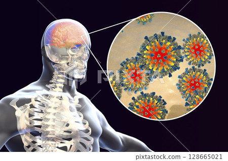 Measles-induced encephalitis, medical concept 128665021