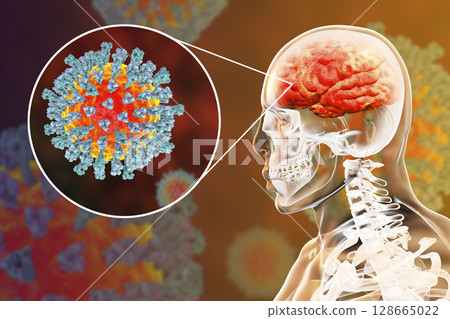 Measles-induced encephalitis, medical concept 128665022
