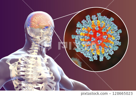 Measles-induced encephalitis, medical concept 128665023