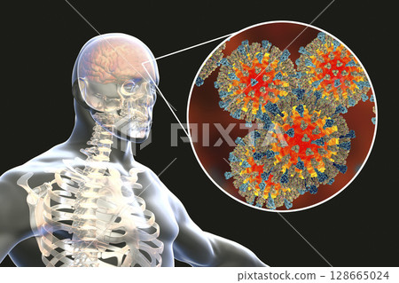 Measles-induced encephalitis, medical concept 128665024