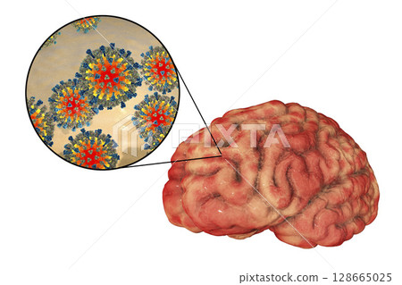 Measles-induced encephalitis, medical concept 128665025